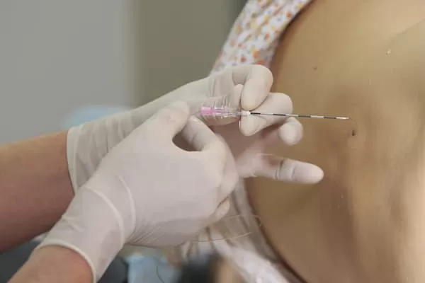 Епідуралка це: механізм блоку і межі безпеки