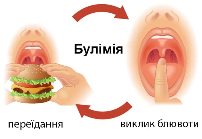 Булімія це: діагноз, цикл і межі розладу