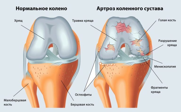Артроз це: що відбувається в суглобі і як з цим жити
